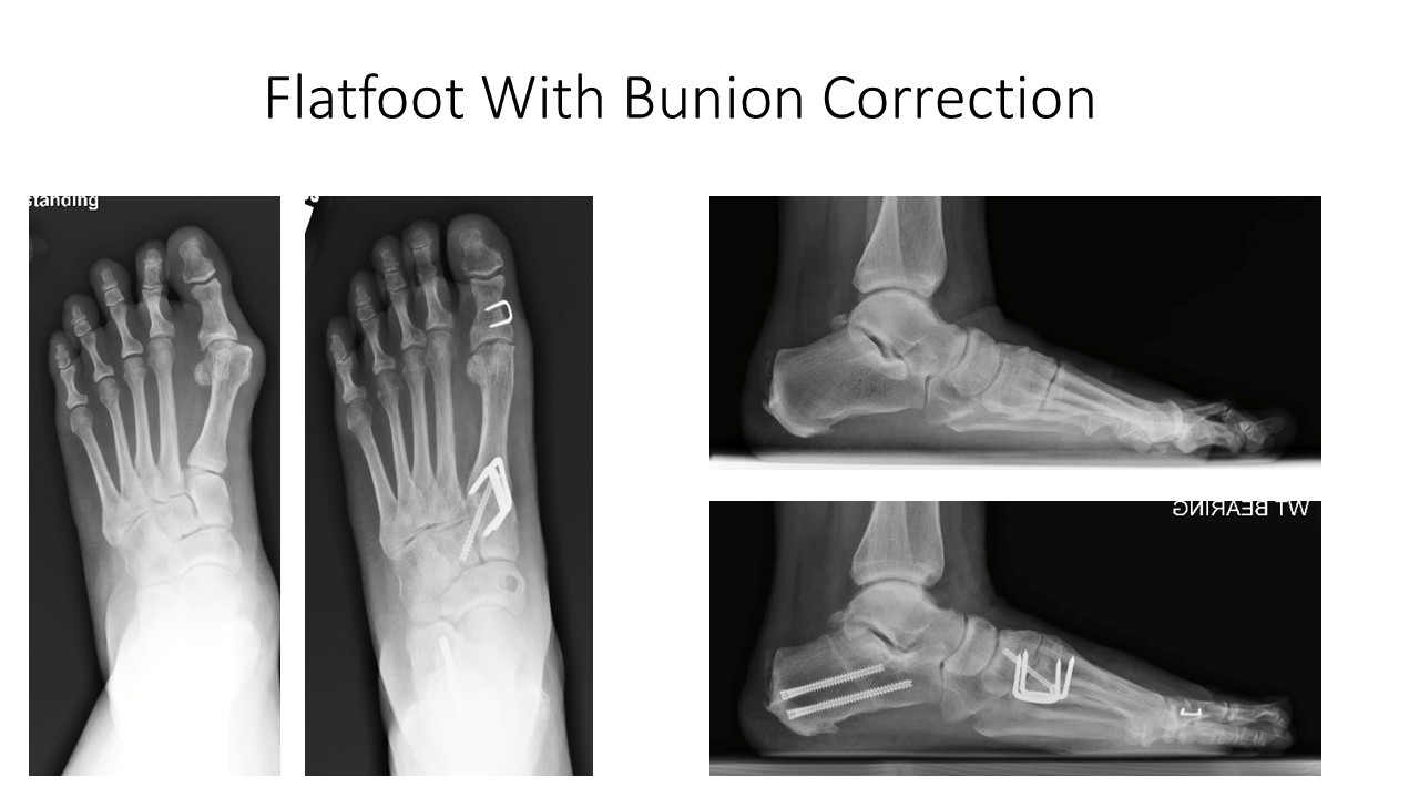 Flatfoot With Bunion Correction