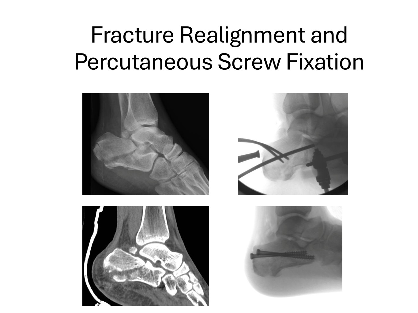 Fracture Realignment And Percutaneous Screw Fixation