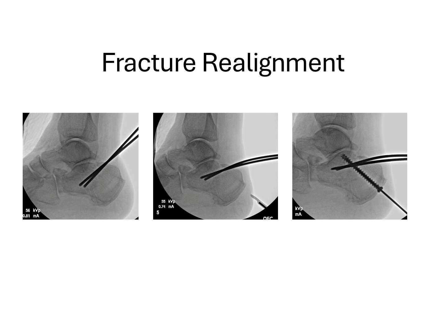 Fracture Realignment Case