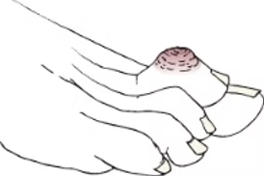 Integrity Orthopedics and Sports Medicine Hammer Toes and Mallet Toes