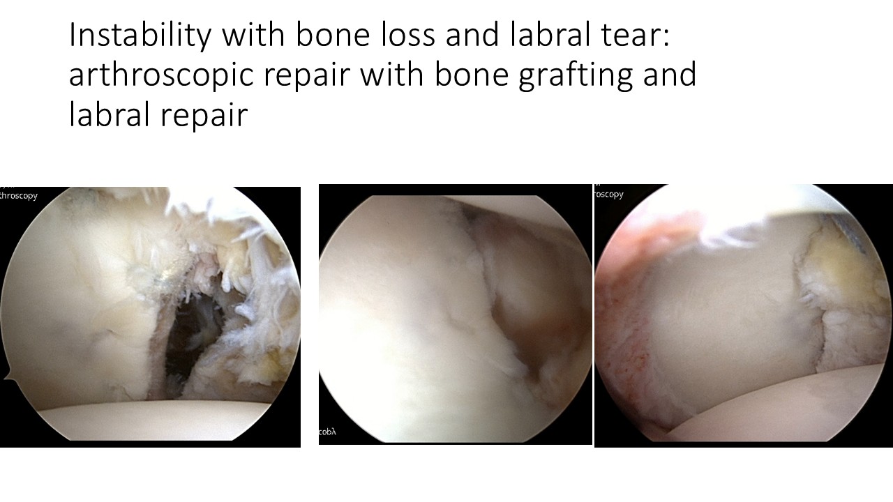Instability With Bone Loss And Labral Tear Arthroscopic Repair With Bone Grafting And Labral Repair