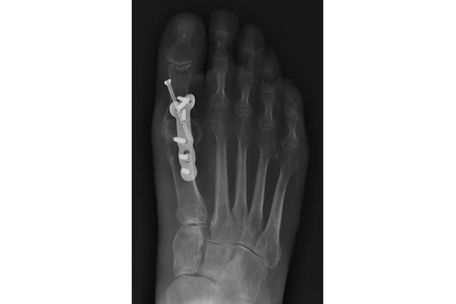 Integrity Orthopedics Hallux Rigidus Arthritis Of The Great Toe