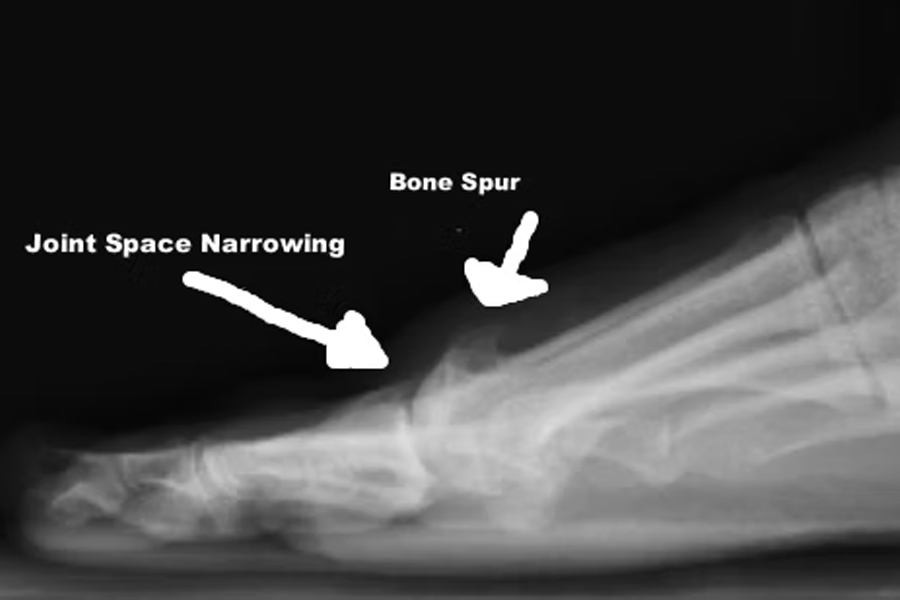 Integrity Orthopedics and Sports Medicine Hallux Rigidus (Arthritis of the Great Toe)