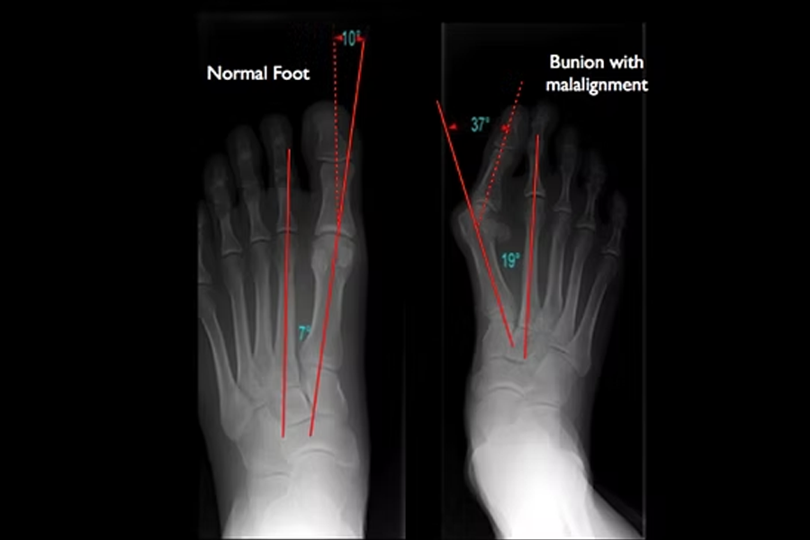 Integrity Orthopedics and Sports Medicine Hallux Valgus (Bunion)