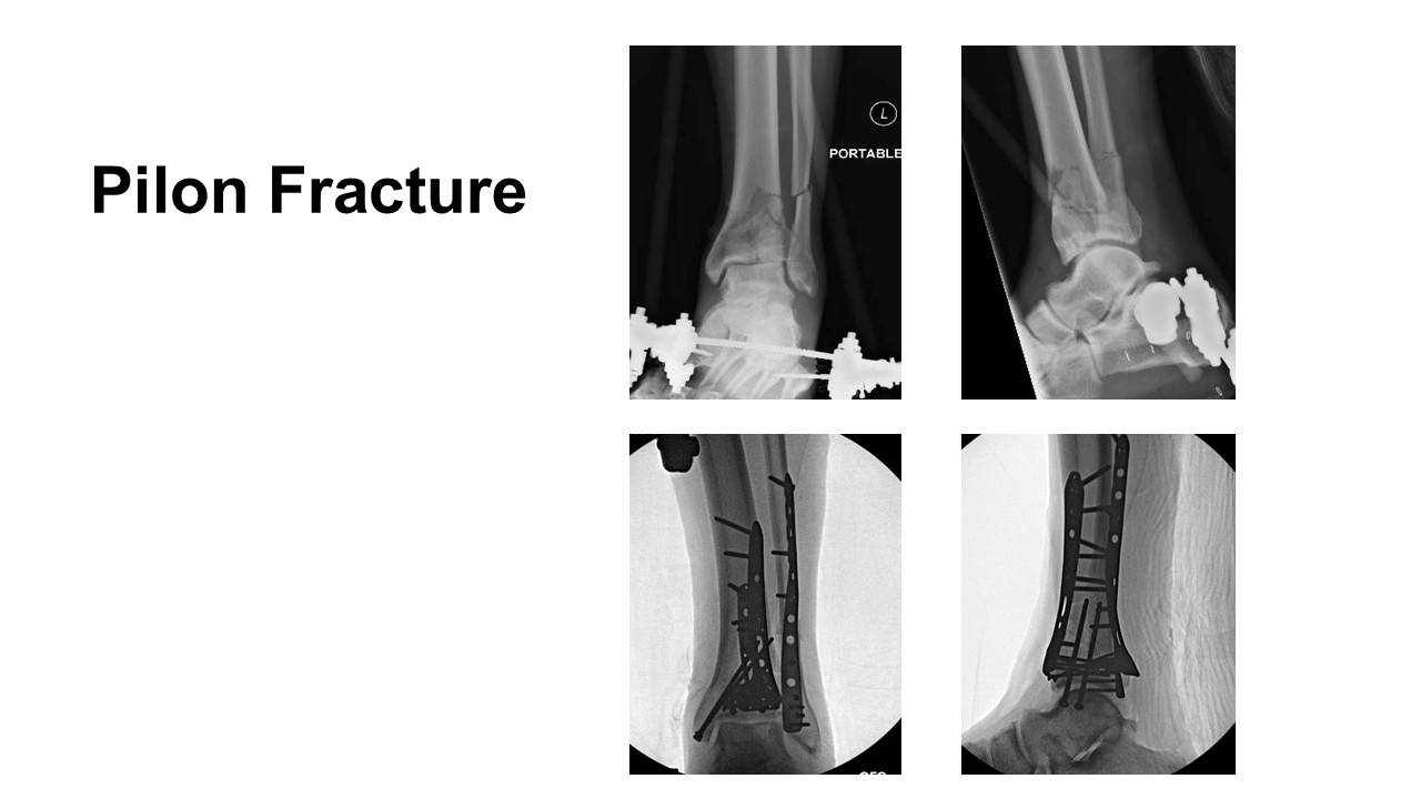 Integrity Orthopedics Pilon Fracture Repair