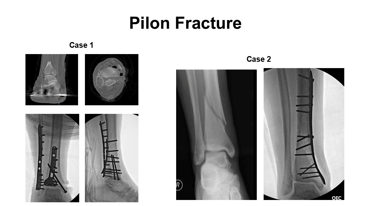 Integrity Orthopedics Pilon Fracture Repair