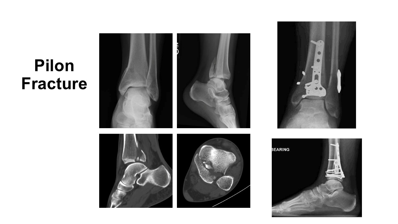 Integrity Orthopedics Pilon Fracture Repair