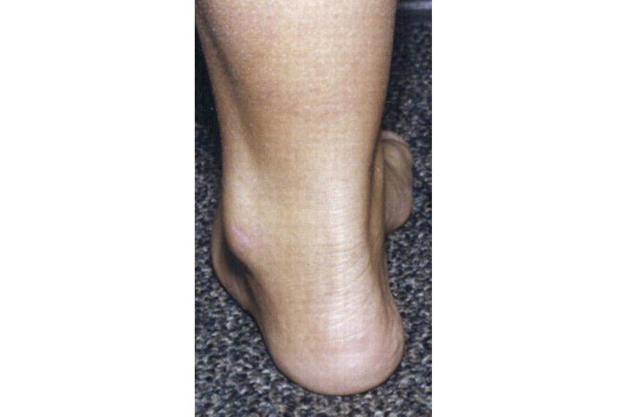 Integrity Orthopedics and Sports Medicine Cavus Foot