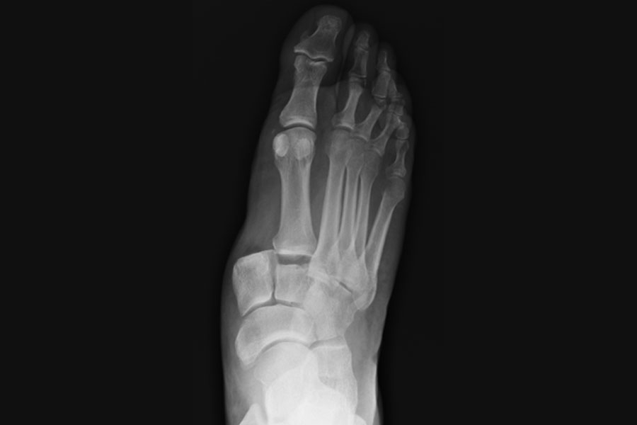 Integrity Orthopedics and Sports Medicine Fractures