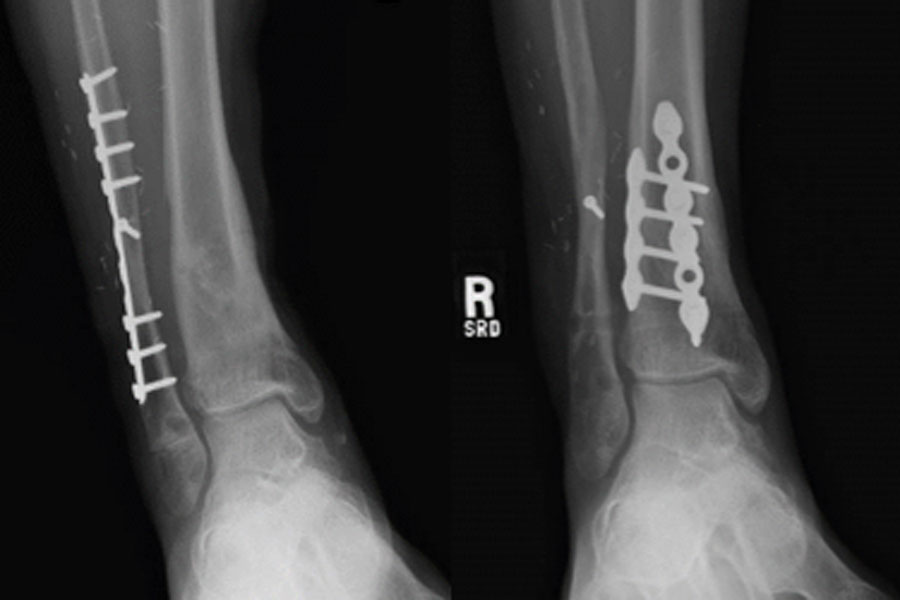 Integrity Orthopedics and Sports Medicine Limb Alignment Correction