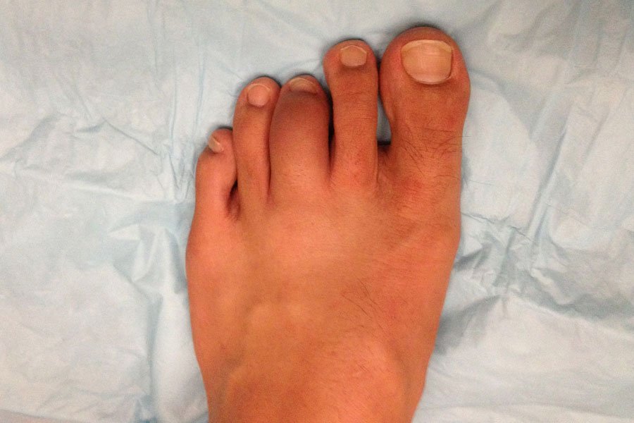 Integrity Orthopedics and Sports Medicine Metatarsalgia