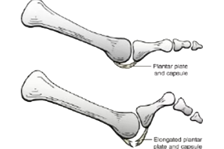 Integrity Orthopedics and Sports Medicine Plantar Plate Tears