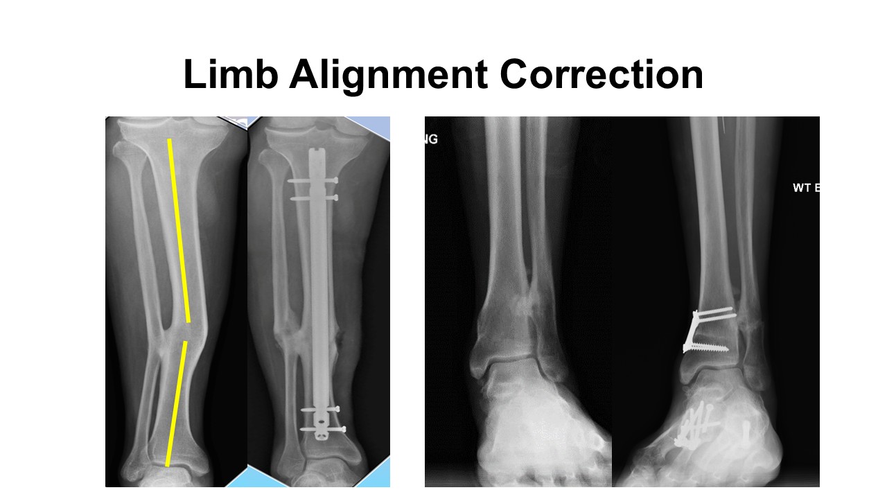 Limb Alignment Correction Chattanooga TN