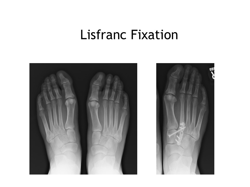 Lisfranc Fixation