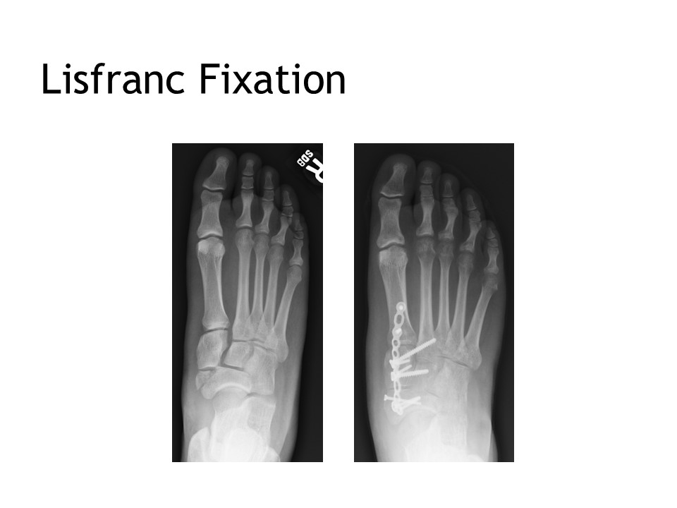 Lisfranc Fixation