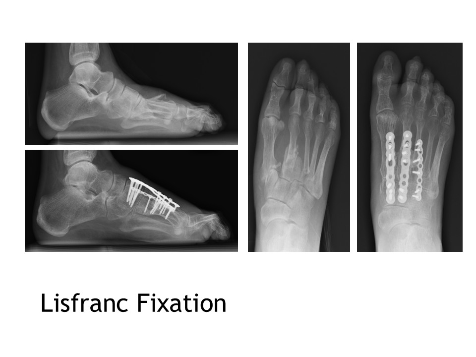 Lisfranc Fixation