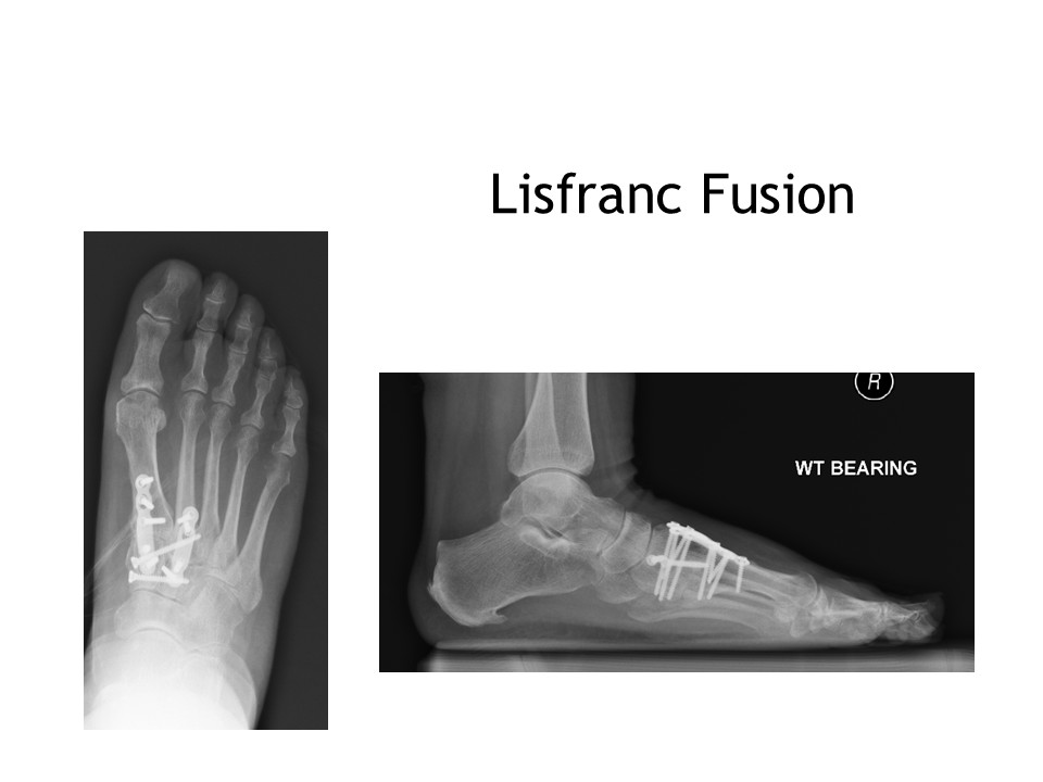 Lisfranc Fusion