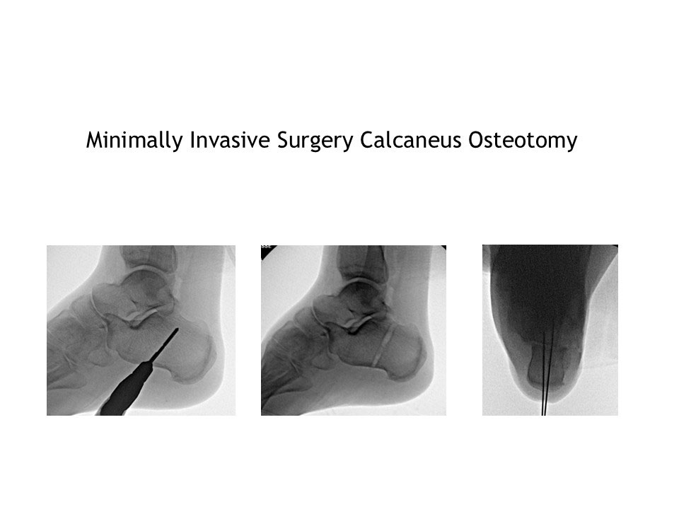 Minimally Invasive Surgery Calcaneus Osteotomy