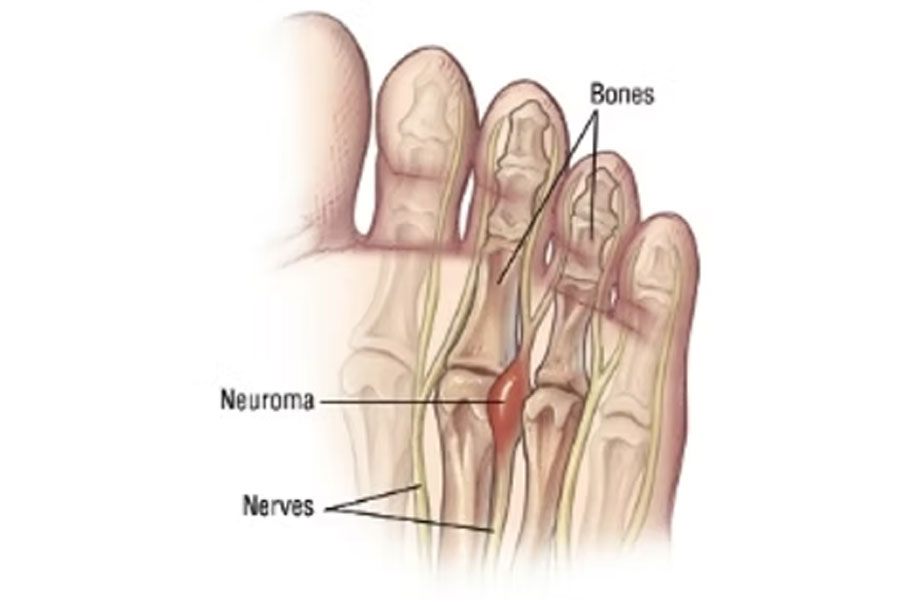Integrity Orthopedics and Sports Medicine Neuroma