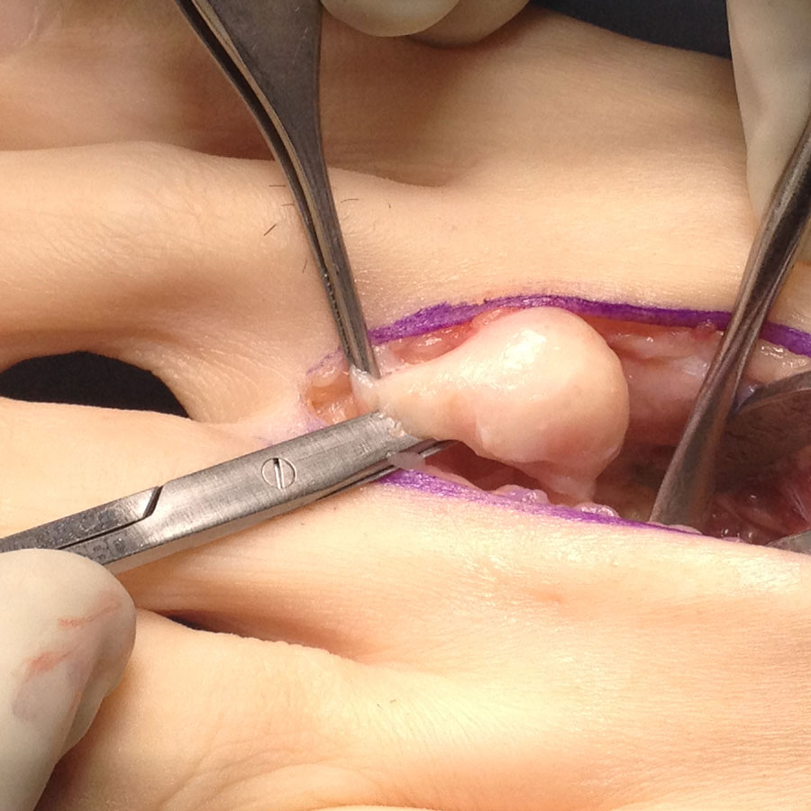 Neuroma Surgical Procedures