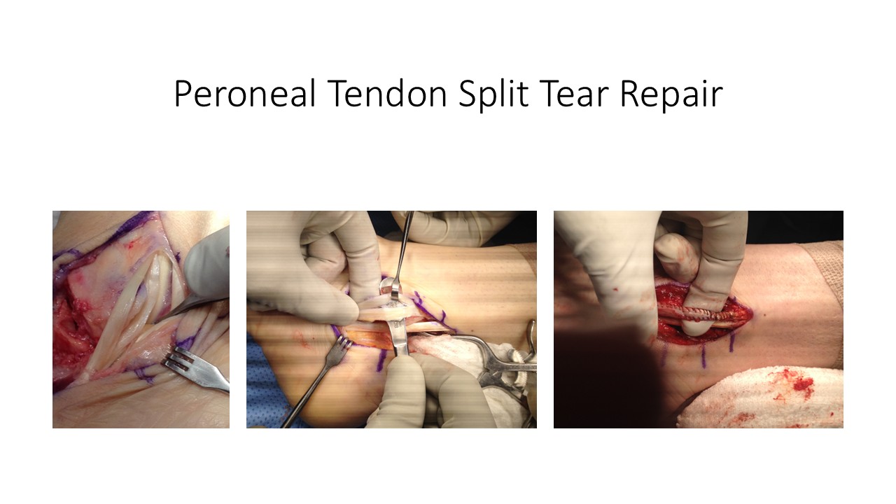 Peroneal Tendon Split Tear Repair