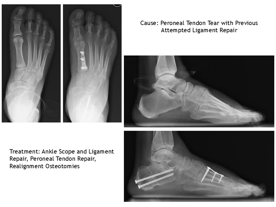 Peroneal Tendon Tear With Previous Attempted Ligament Repair