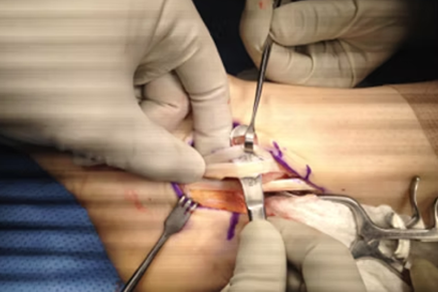 Peroneal Tendons