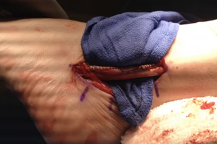 Peroneal Tendons