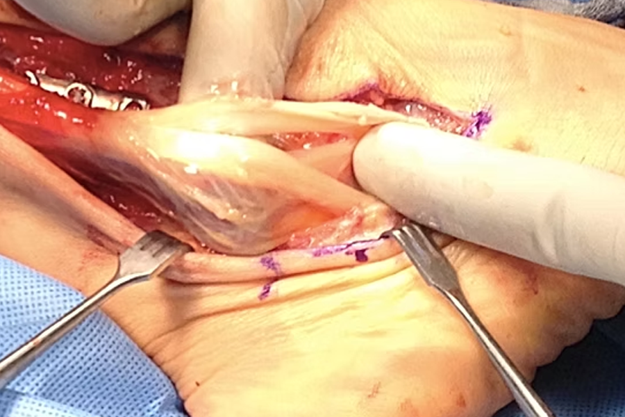 Peroneal Tendons With Inflammation And Synovitis