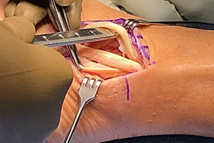 Peroneal Tendons With Inflammation And Synovitis