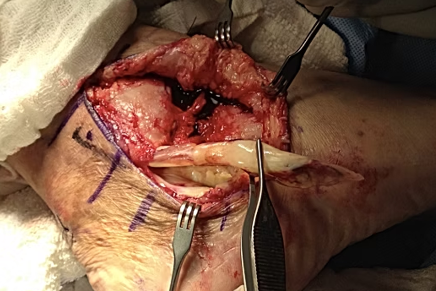 Peroneal Tendons With Inflammation And Synovitis