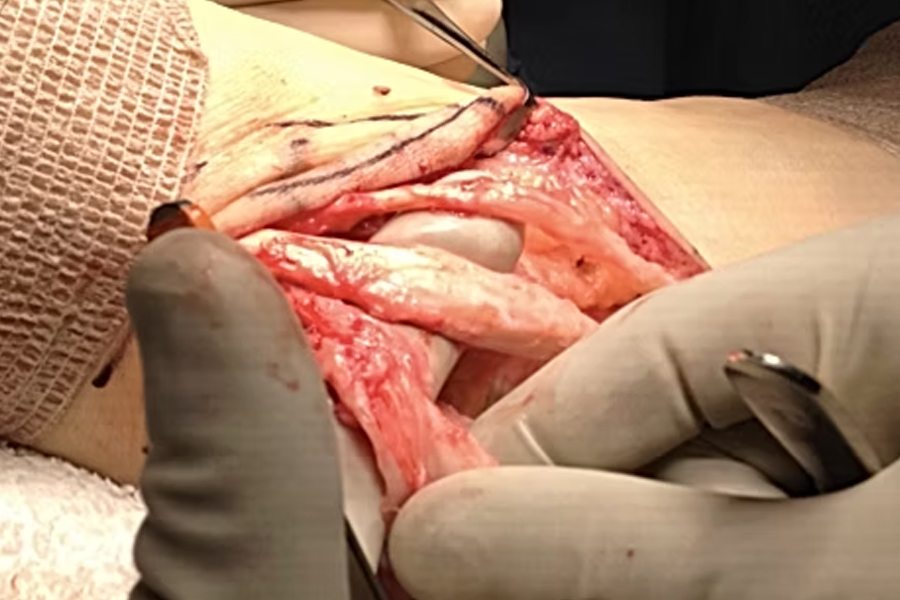 Peroneal Tendons With Inflammation And Synovitis