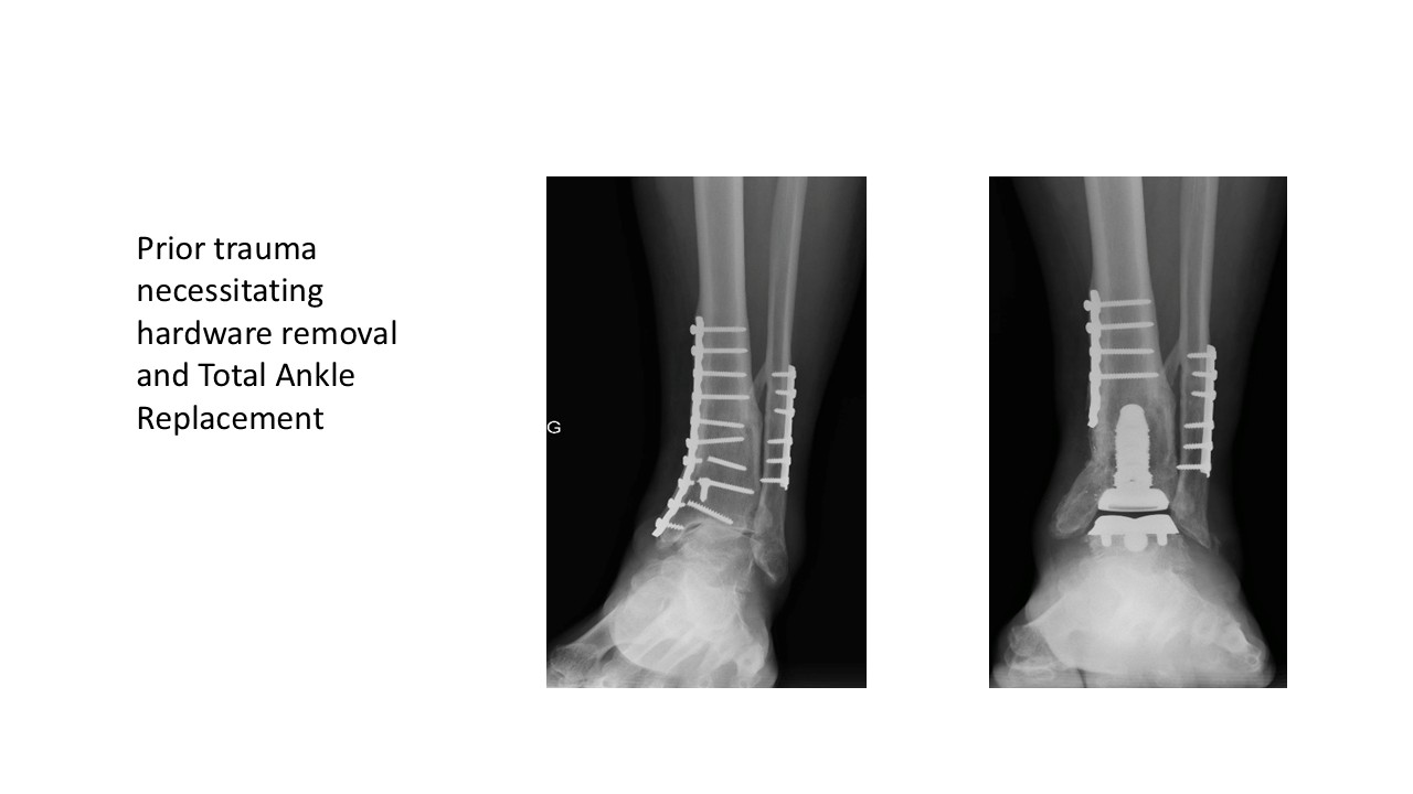 Prior Trauma Necessitating Hardware Removal And Total Ankle Replacement