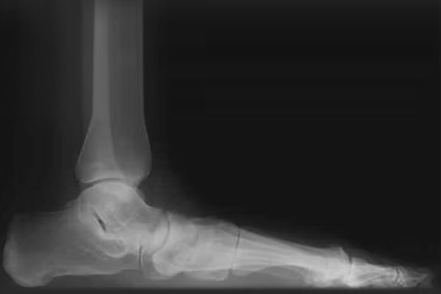 Integrity Orthopedics and Sports Medicine Progressive Collapsing Foot Deformity (Flatfoot)