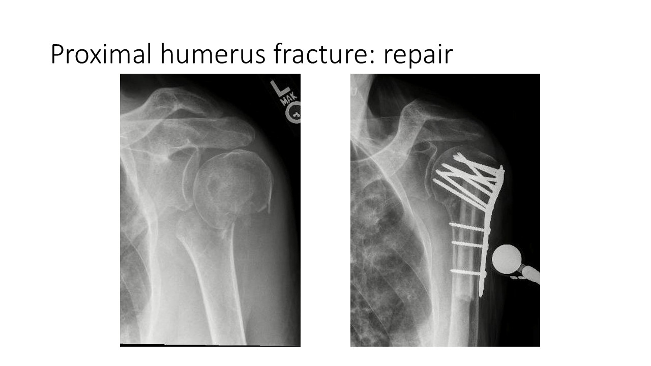 Proximal Humerus Fracture Repair