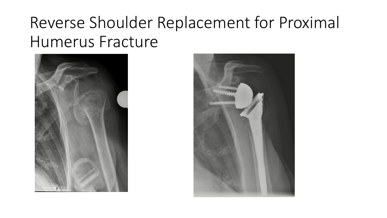 Reverse Shoulder Replacement For Proximal Humerus Fracture