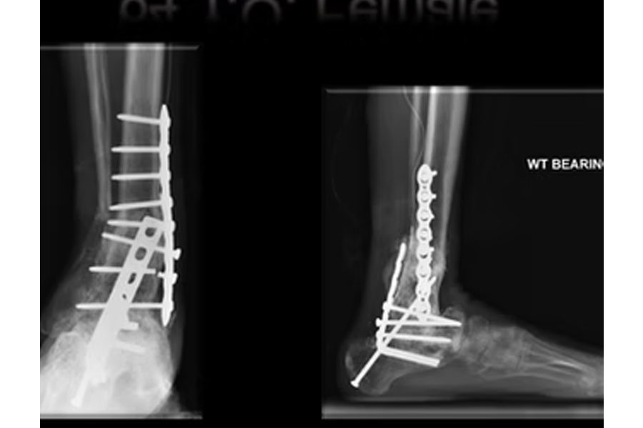 Revision Of An Unsuccessful Surgery Attempted Years Ago With Utilization Of A Hindfoot Fusion Nail To Fix It