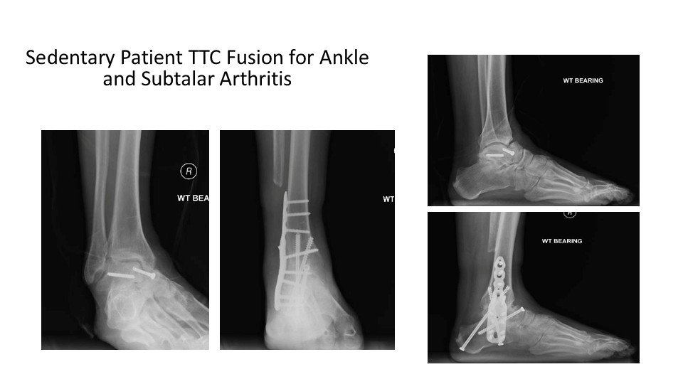 Sedentary Patient TTC Fusion For Ankle And Subtalar Arthritis