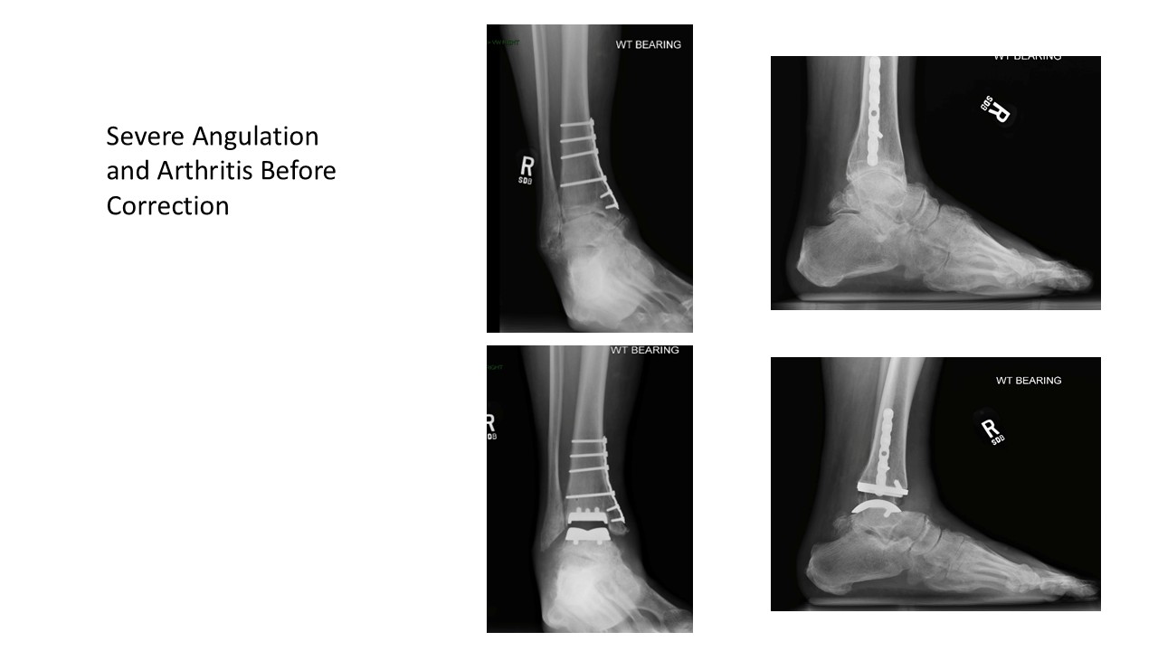 Severe Angulation And Arthritis Before Correction