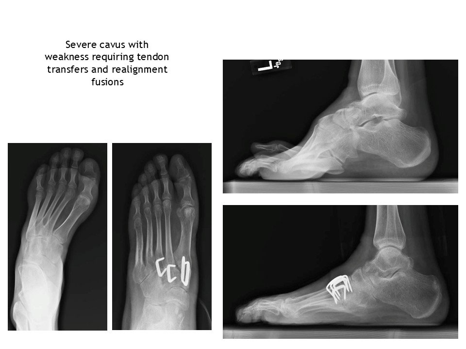 Severe Cavus With Weakness Requiring Tendon Transfers And Realignment Fusions