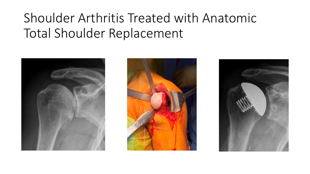 Shoulder Arthritis Treated With Anatomic Total Shoulder Replacement
