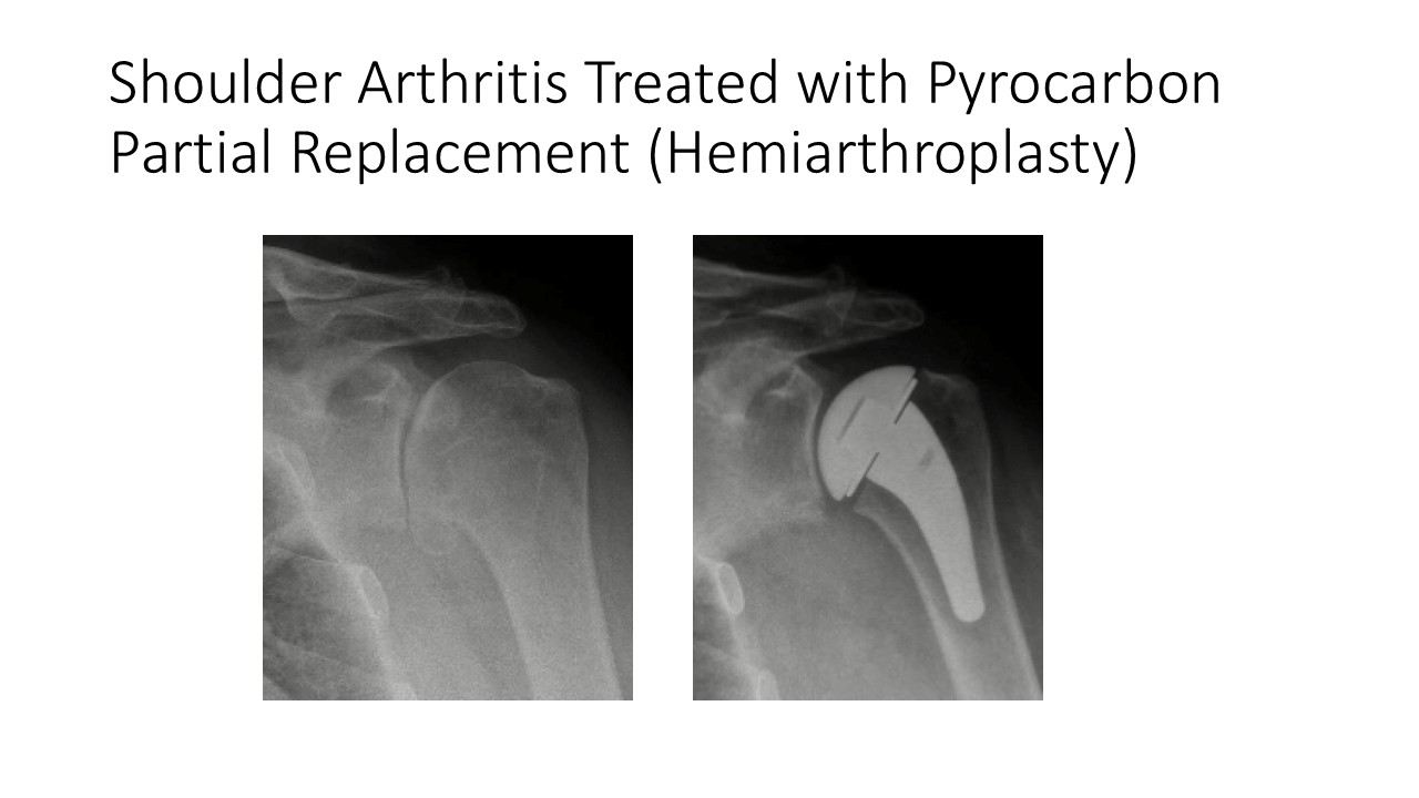 Shoulder Arthritis Treated With Pyrocarbon Partial Replacement Hemiarthroplasty