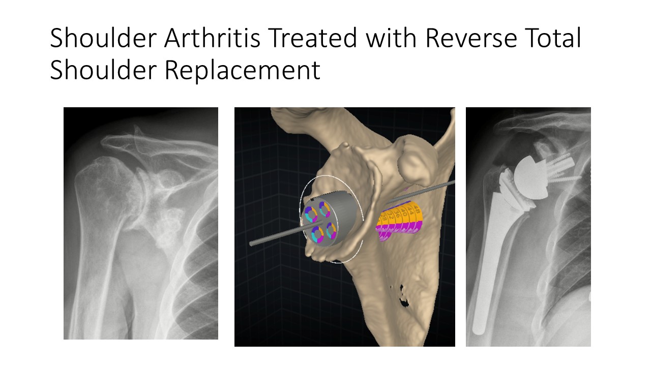 Shoulder Arthritis Treated With Reverse Total Shoulder Replacement