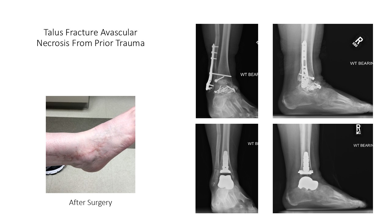 Talus Fracture Avascular Necrosis From Prior Trauma