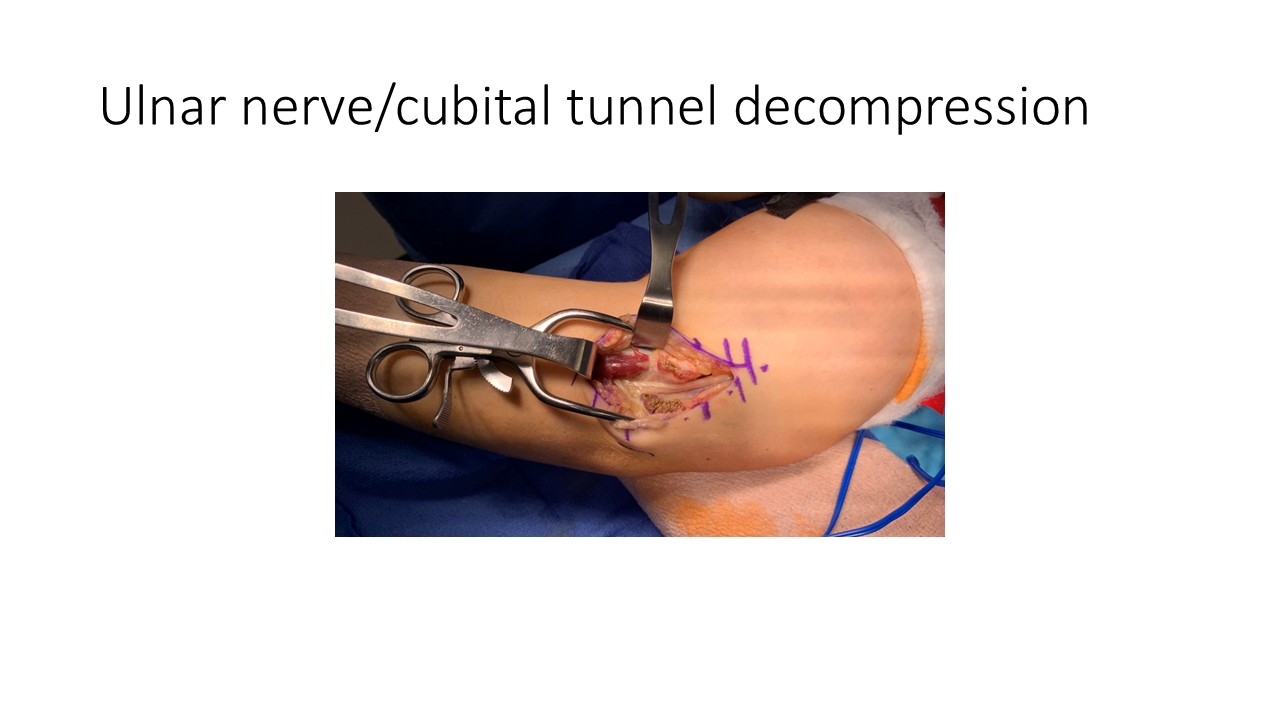 Ulnar Nervecubital Tunnel Decompression